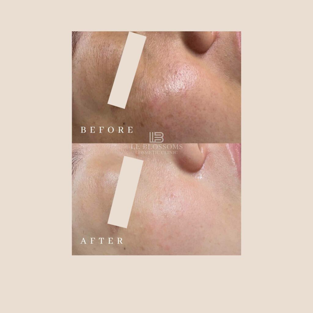 Instagram B/A Templates - Horizontal Template