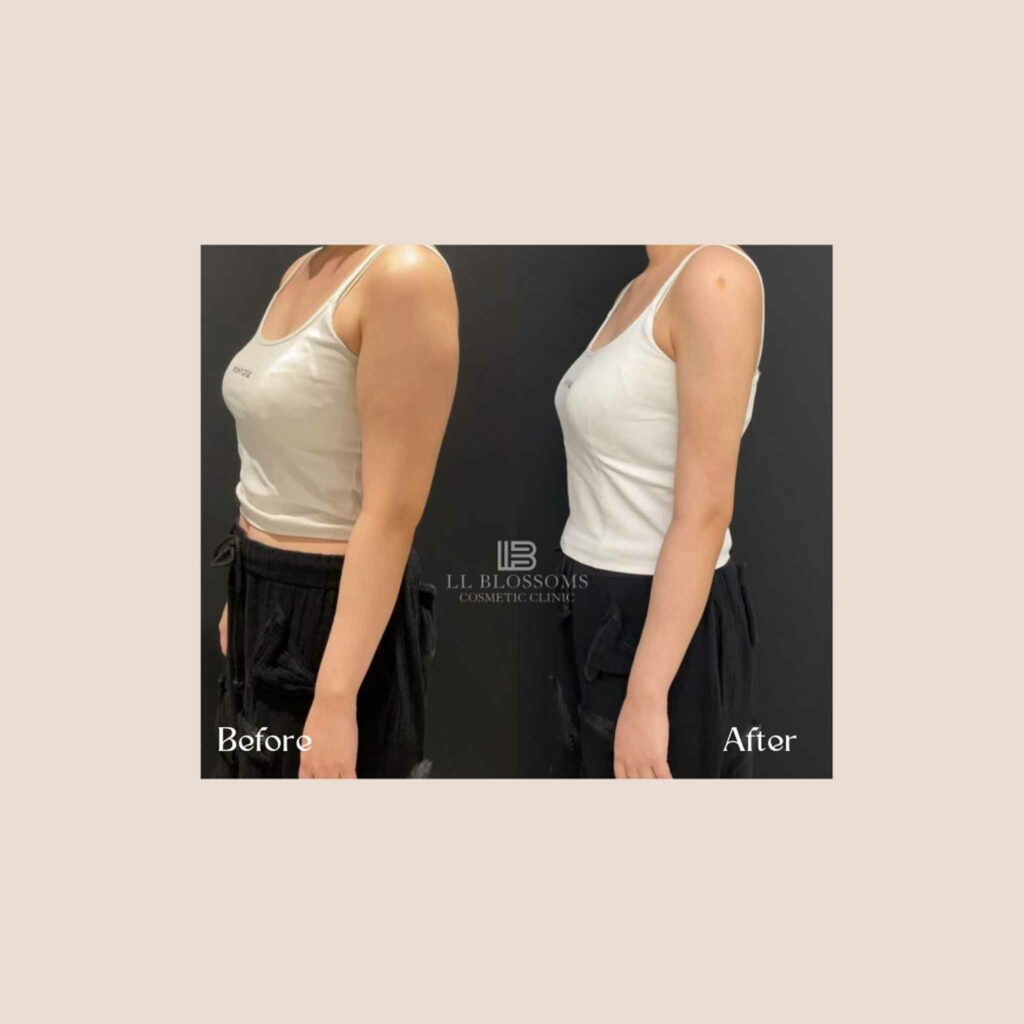 Instagram B/A Templates - 2