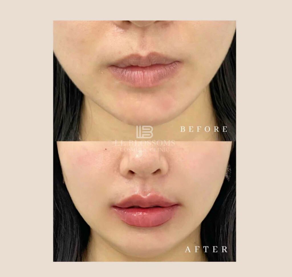lipfiller